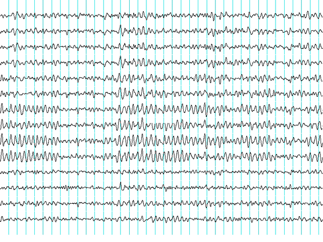 EEG waveforms